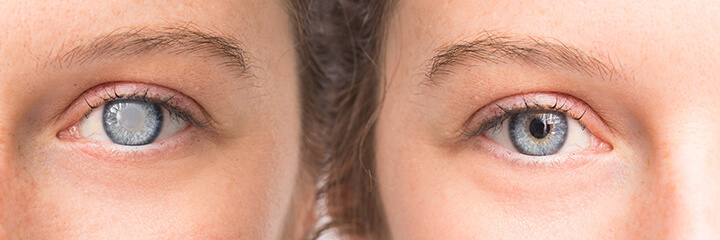 Before and after cataract surgery