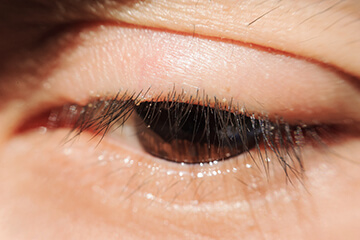 Blepharitis of top eyelid