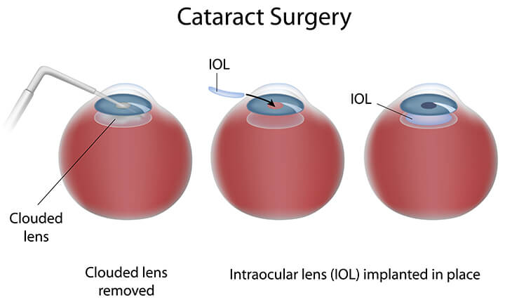 Diagram of Cataract Surgery