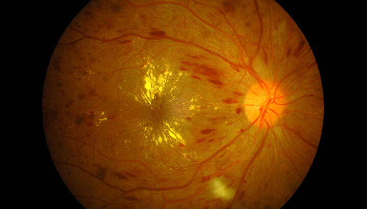 Macular Degeneration