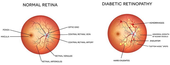 Illustration of normal retinal vs diabetic rinopathy