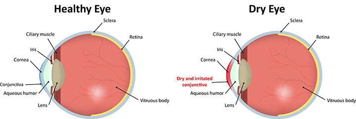 Diagram showing dry eye compared to healthy eye