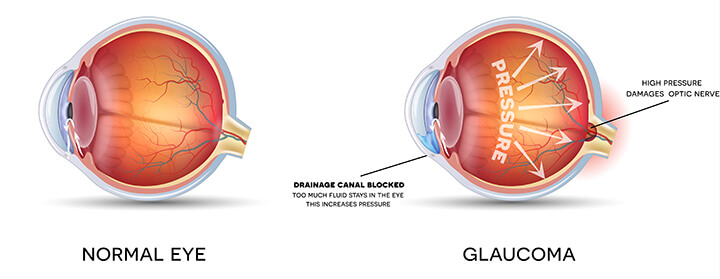 Glaucoma medical illustration