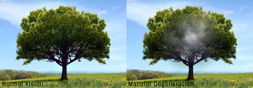 Example of how macular degeneration affects the vision