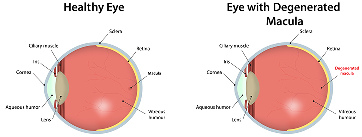 Healthy Eye vs Eye with Degenerated Macula